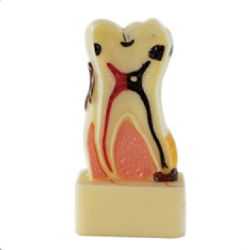 Jingle JG-YS6 — Модель с 4 видами заболеваний пародонта