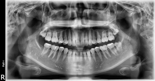 Vatech Pax-i - ортопантомограф_2.jpg