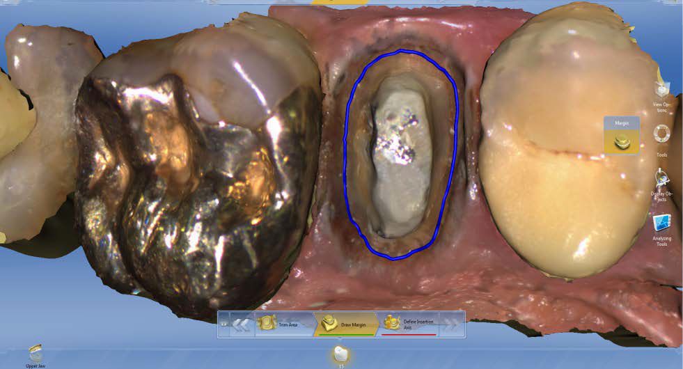 CEREC AC OMNICAM ПРОСТОЕ СКАНИРОВАНИЕ БЕЗ АНТИБЛИКОВОГО СПРЕЯ 6.jpg