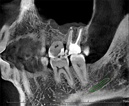 GENORAY Papaya 3D 23x14 - компьютерный томограф с цефалостатом One Shot 