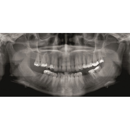 KaVo GENDEX GXDP-300 - цифровая панорамная рентгенодиагностическая система