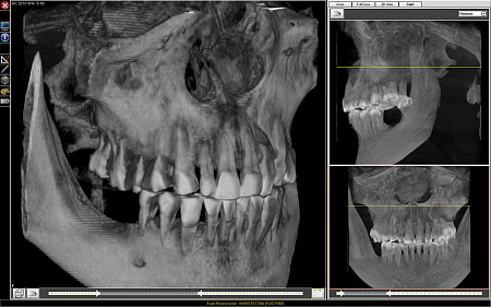 FONA XPan 3D - рентгенографическая цифровая система панорамной съемки