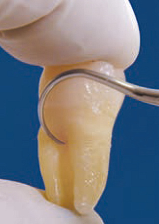 Acteon насадка для скайлера TK2-1L – левосторонняя насадка, используется в средних и глубоких карманах с фуркациями (более 4 мм), (пародонт)