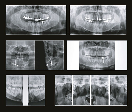 GENORAY Papaya 3D Plus 16x8 - компьютерный томограф с цефалостатом