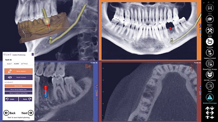 Exocad DICOM viewer - средство просмотра DICOM файлов