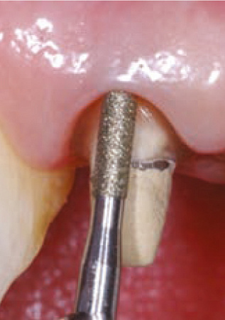 Acteon PMS1 – Насадка для скайлера с алмазным покрытием